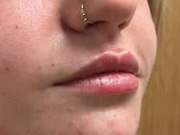 Dermal Fillers Before & After Image