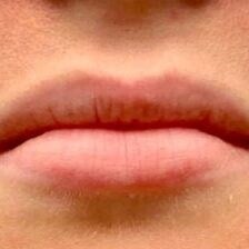 Restylane Before & After Image