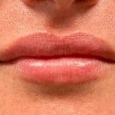 Restylane Before & After Image