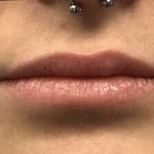 Restylane Before & After Image