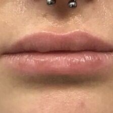 Restylane Before & After Image