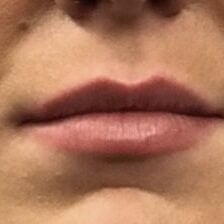 Restylane Before & After Image