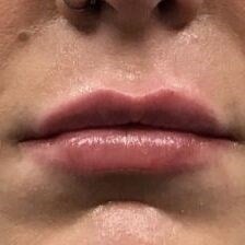 Restylane Before & After Image