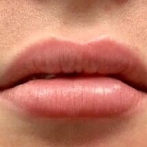 Restylane Before & After Image