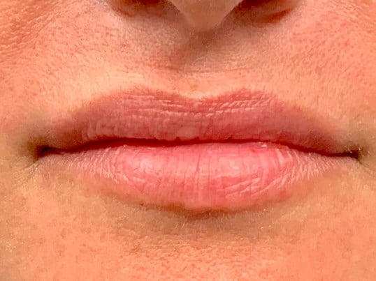 Revanesse Versa Before & After Image