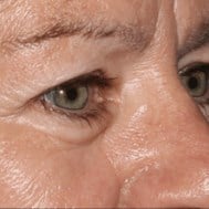 Blepharoplasty Before & After Image