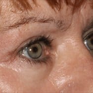 Blepharoplasty Before & After Image