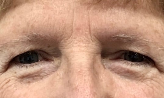 Blepharoplasty Before & After Image