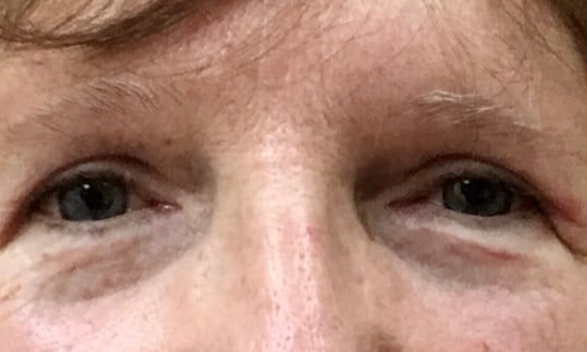 Blepharoplasty Before & After Image