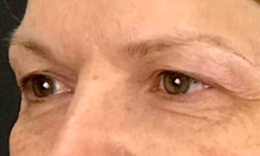 Blepharoplasty Before & After Image
