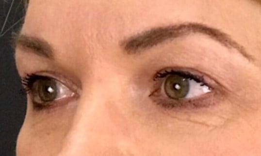 Blepharoplasty Before & After Image