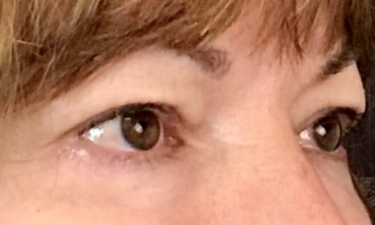Blepharoplasty Before & After Image