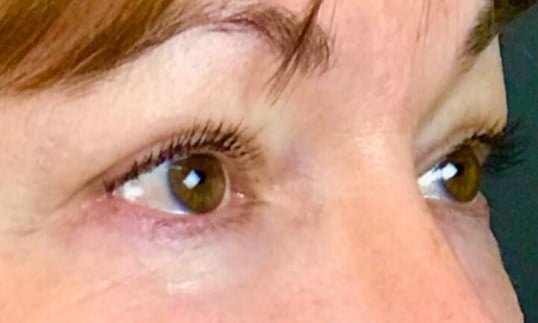 Blepharoplasty Before & After Image