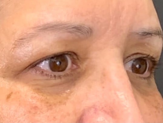 Blepharoplasty Before & After Image