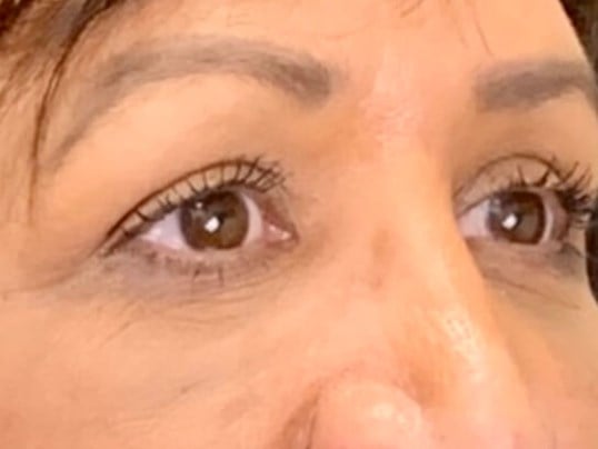 Blepharoplasty Before & After Image