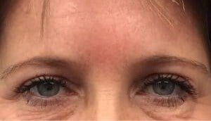 Brow And Forehead Lift Before & After Image