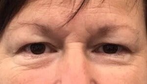 Brow And Forehead Lift Before & After Image