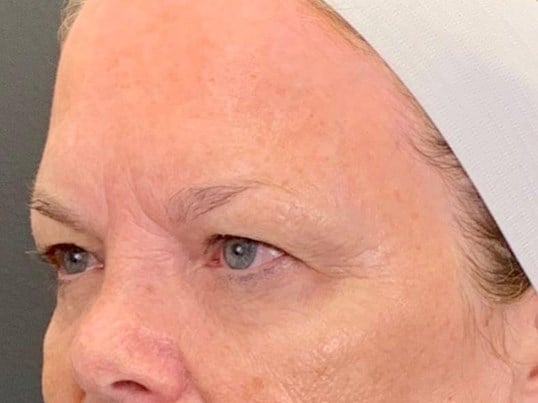 Brow And Forehead Lift Before & After Image