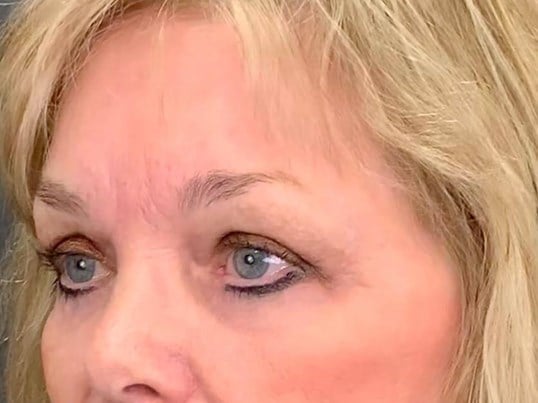 Brow And Forehead Lift Before & After Image
