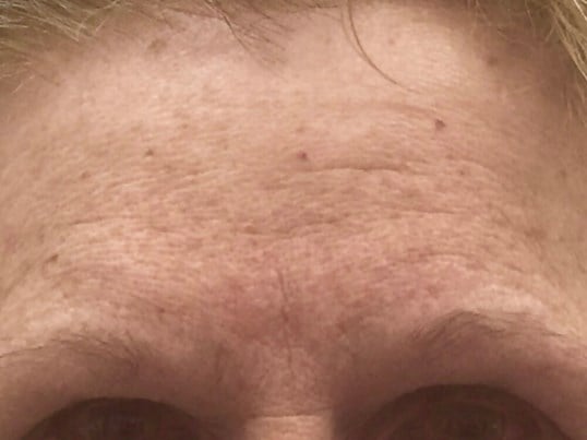 Brow And Forehead Lift Before & After Image