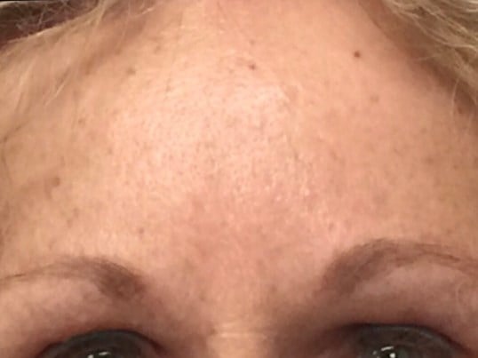 Brow And Forehead Lift Before & After Image