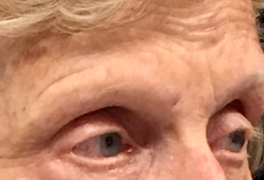 Brow And Forehead Lift Before & After Image