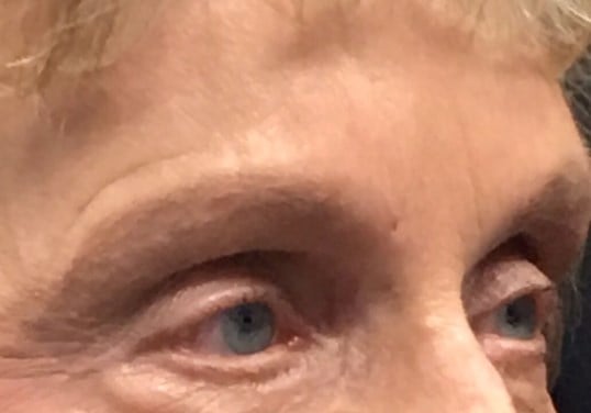 Brow And Forehead Lift Before & After Image