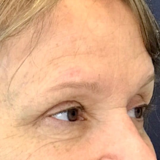 Brow And Forehead Lift Before & After Image