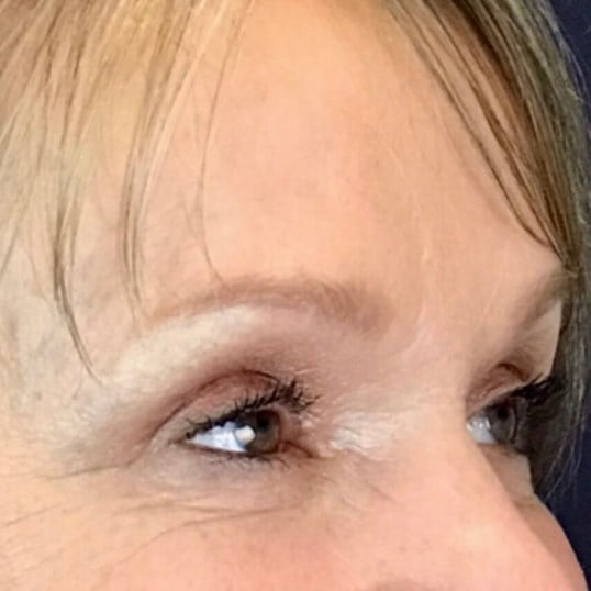 Brow And Forehead Lift Before & After Image
