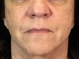Facelift Before & After Image