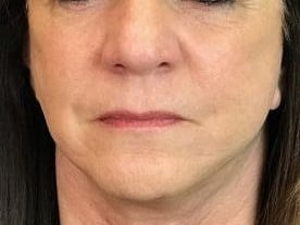 Facelift Before & After Image