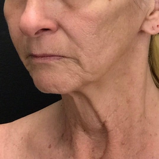 Facelift Before & After Image