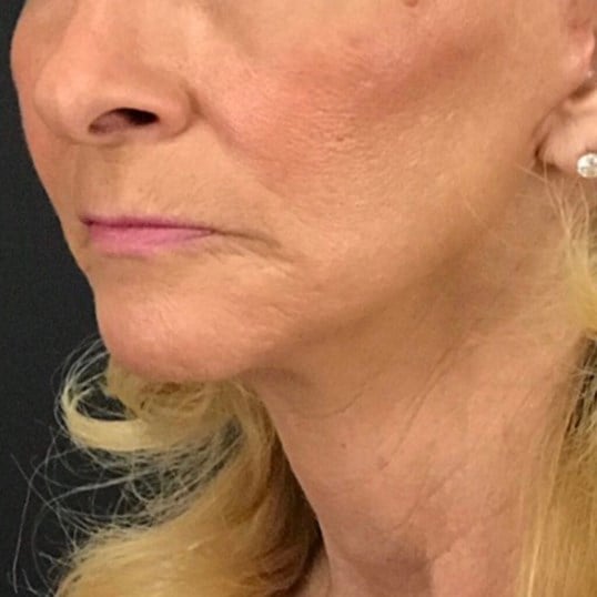 Facelift Before & After Image