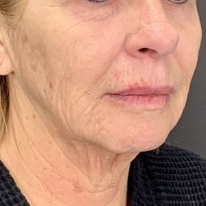 Facelift Before & After Image