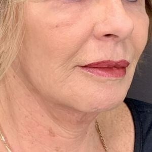 Facelift Before & After Image
