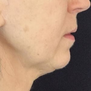 Facelift Before & After Image