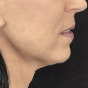 Facelift Before & After Image