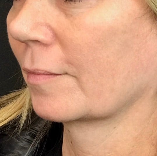 Facelift Before & After Image