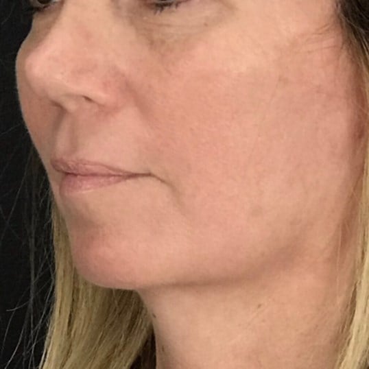 Facelift Before & After Image