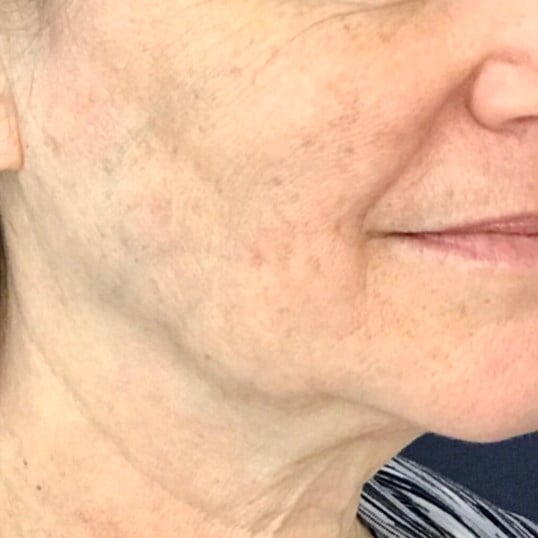 Facelift Before & After Image