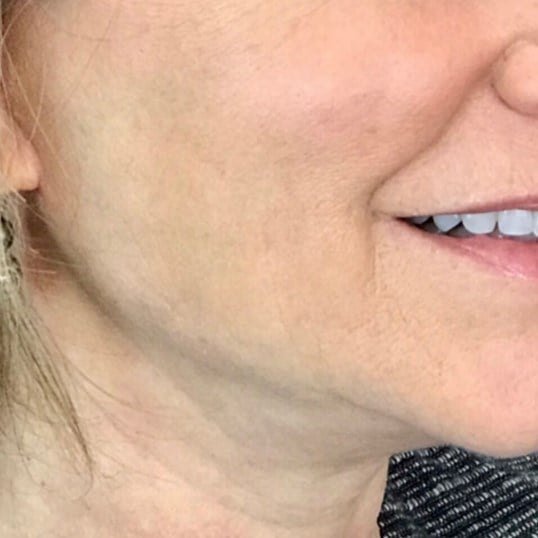 Facelift Before & After Image
