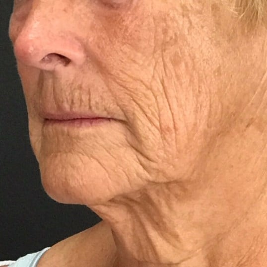 Facelift Before & After Image