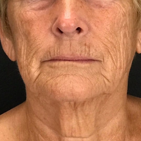 Facelift Before & After Image