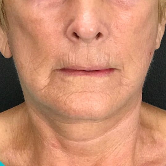 Facelift Before & After Image