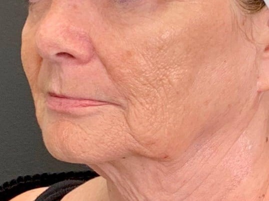 Facelift Before & After Image