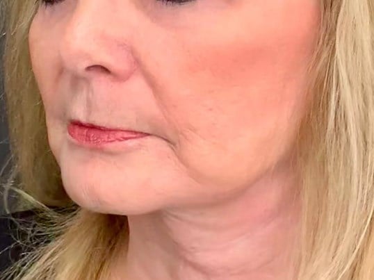 Facelift Before & After Image