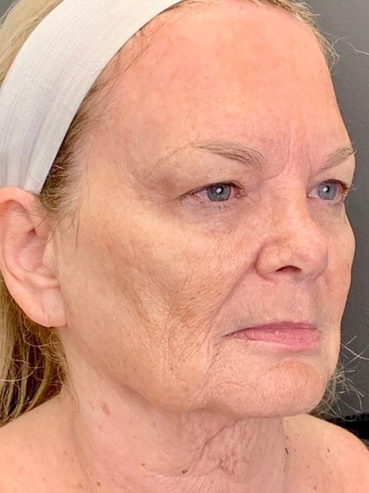 Facelift Before & After Image