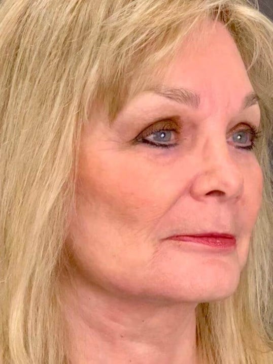 Facelift Before & After Image