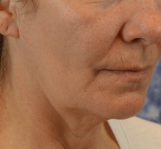 Facelift Before & After Image