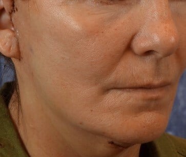 Facelift Before & After Image